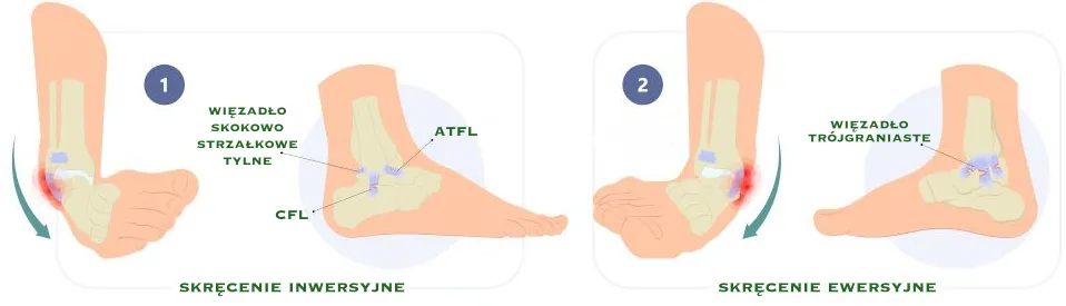skręcenie stawu skokowego fizjoterapia katowice
