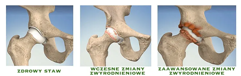 fizjoterapia po endoprotezie stawu biodrowego - stopnie zwyrodnienia