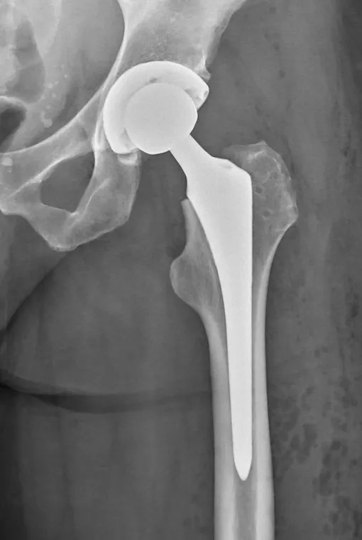 fizjoterapia po endoprotezie stawu biodrowego katowice centrum