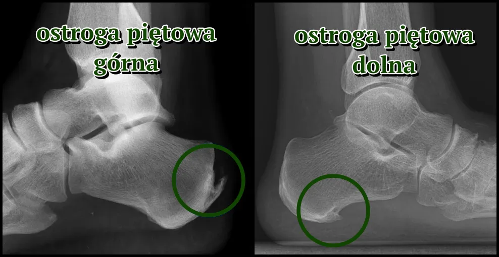 ostroga piętowa fizjoterapeuta katowice