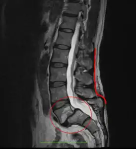 kręgoszczelina i kręgozmyk