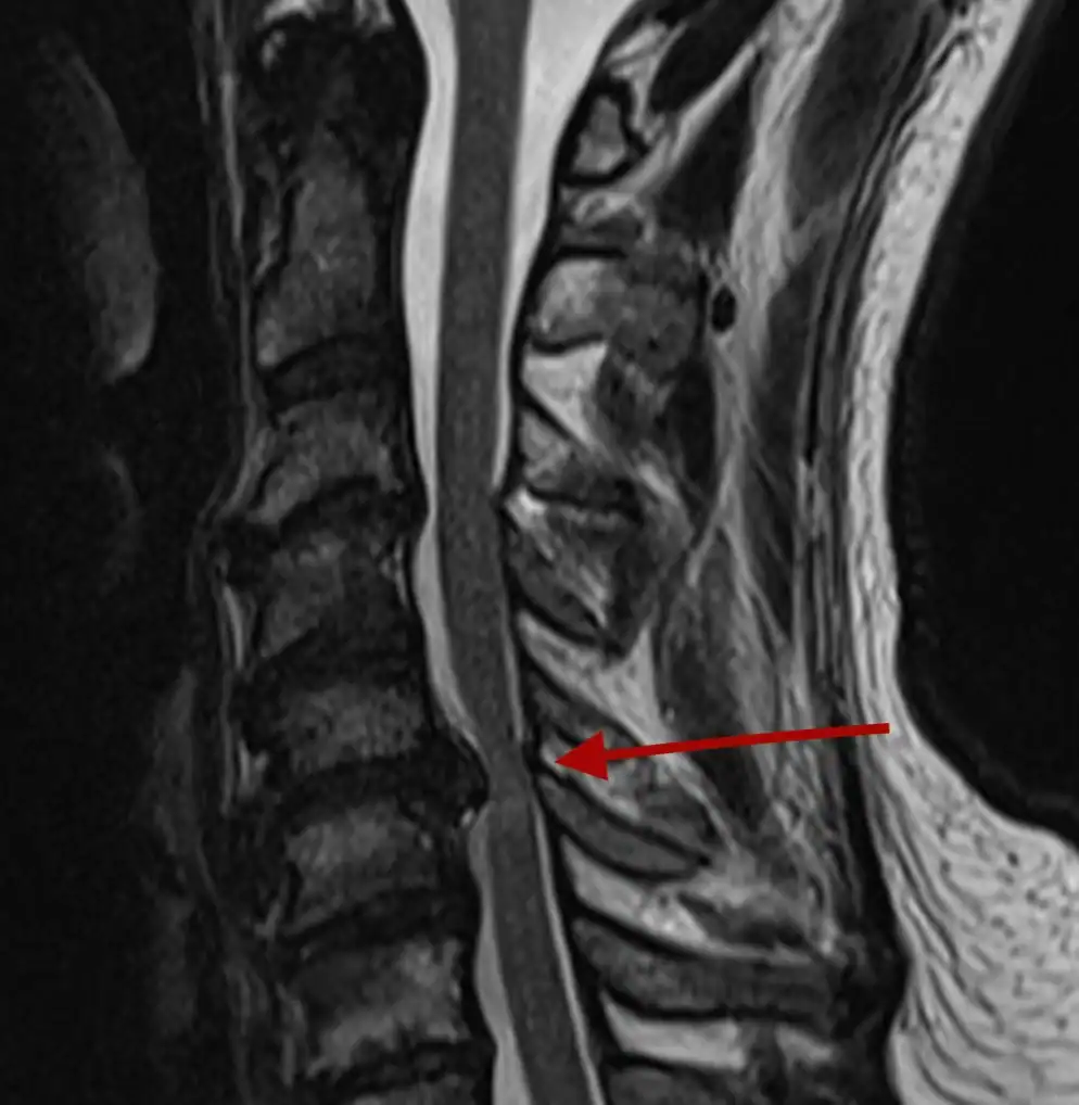 mielopatia szyjna fizjoterapia katowice