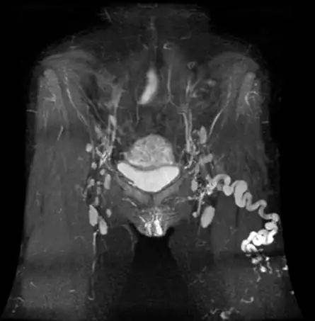 niewydolność żylna miednicy a ból kręgosłupa