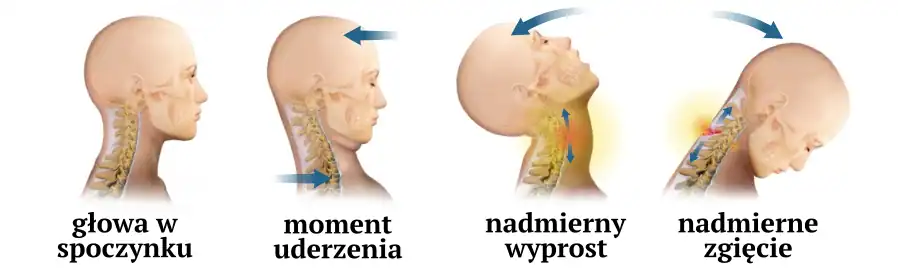 mechanizm urazu szyi podczas wypadku typu whiplash