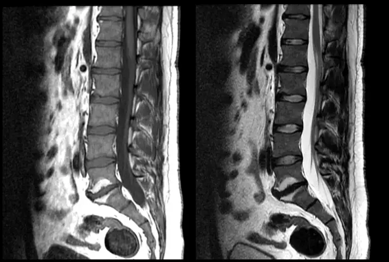 zmiany modic w mri kręgosłupa lędźwiowego katowice