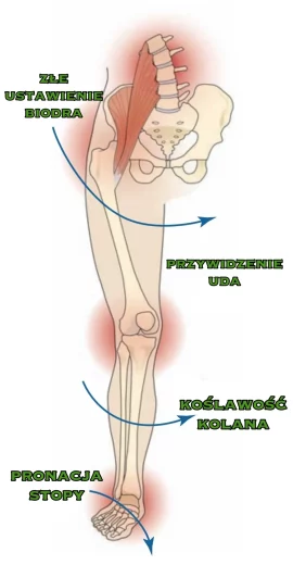 ból biodra po skręceniu kostki fizjoterapia katowice