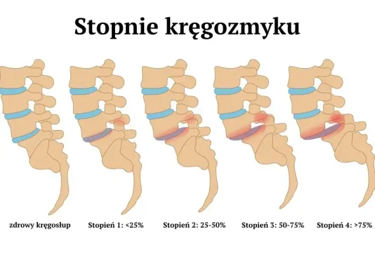 kręgozmyk - stopnie wg skali Meyerdinga