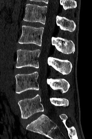 tomografia komputerowa w ocenie kręgosłupa lędźwiowego